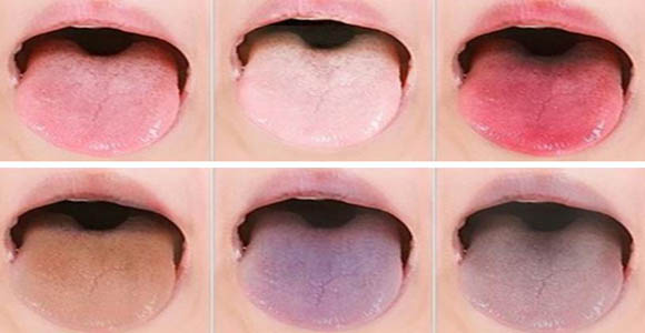 혀 색깔로 알아보는 몸의 건강 상태 | 오펀 디스커스